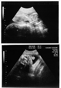 pränatalen Diagnostik pränatalen Diagnostik