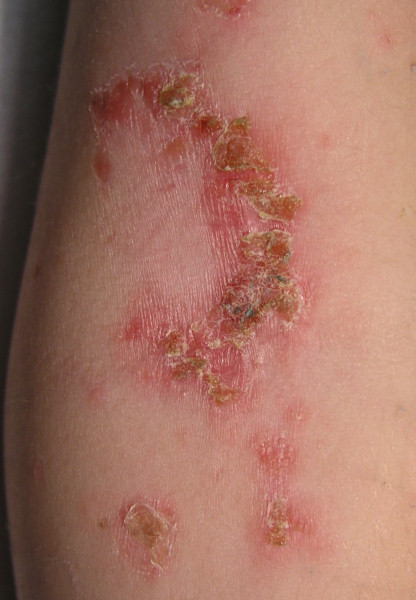 Impetigo contagiosa (Grindflechte, Borkenflechte) am Ellenbogen Impetigo contagiosa (Grindflechte, Borkenflechte) am Ellenbogen