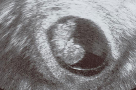 Embryo-Ultraschallbild in der 10. SSW Embryo-Ultraschallbild in der 10. SSW