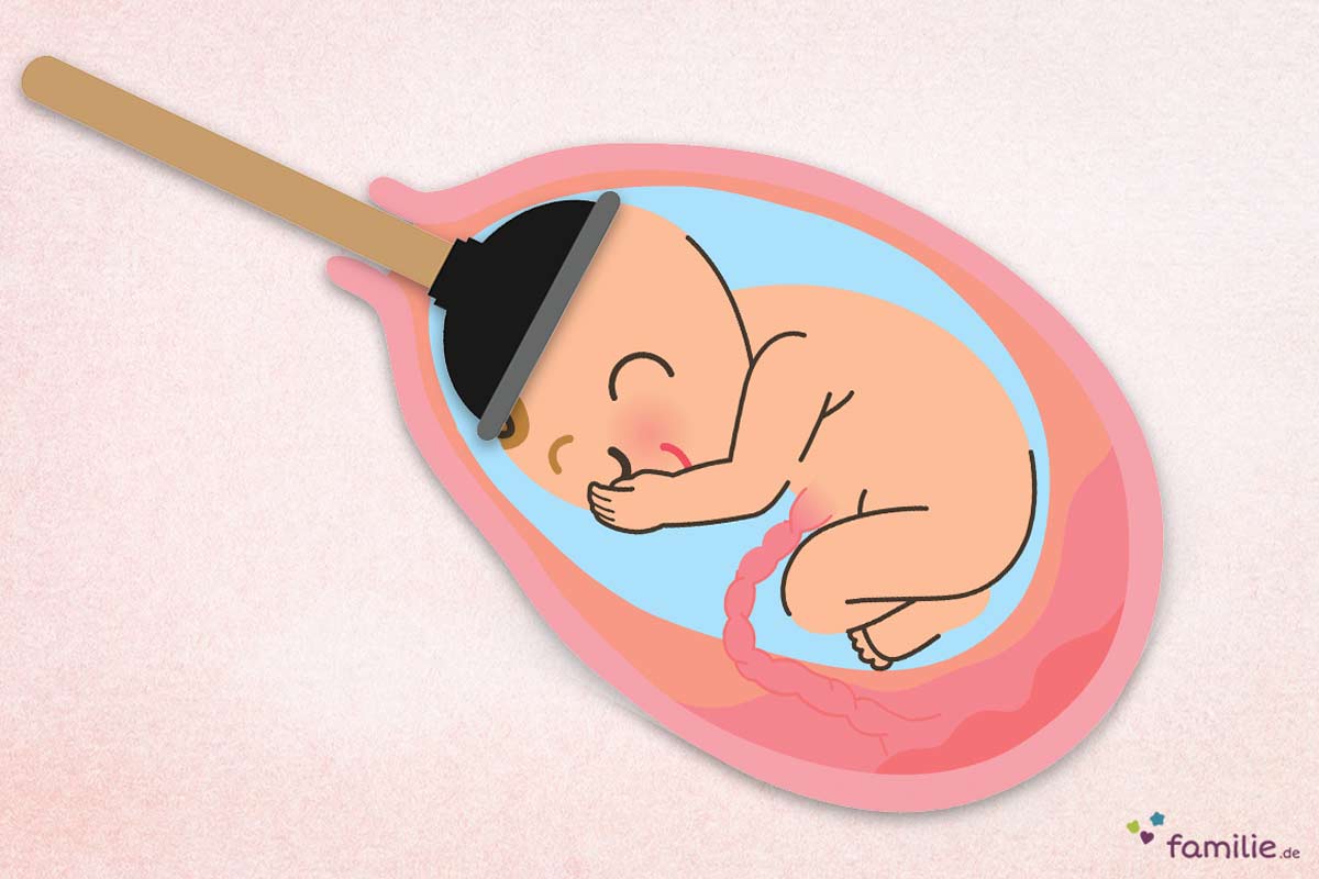 Wann die Saugglocke zum Einsatz kommt