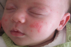 Ausschlag: Babyakne Ausschlag: Babyakne