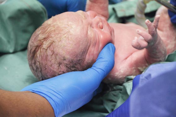 Dieses Baby wurde zweimal geboren