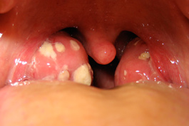 Eitrige Angina