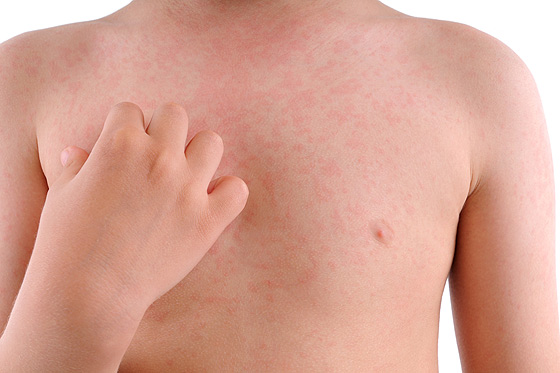 Erste Hilfe: Allergische Reaktion