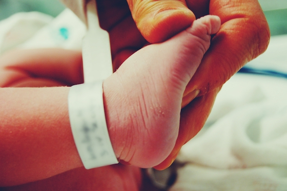 Sichelfuß beim Baby
