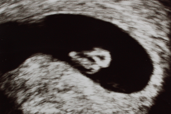 Ultraschallbild SSW 5