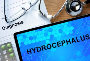 Ein Hydrocephalus ist nicht heilbar, die Symptome können aber gelindert werden.