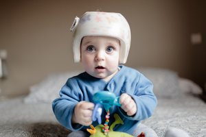 Manche Kleinkinder brauchen schon vor dem Fahrradhelm eine Kopforthese.